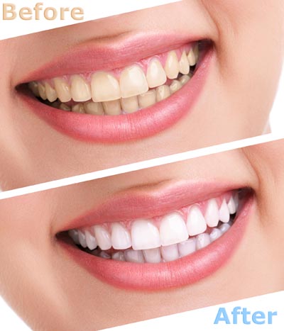 teeth whitening Bensalem, PA