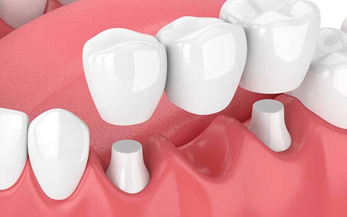 Dental Crowns and Dental Bridges