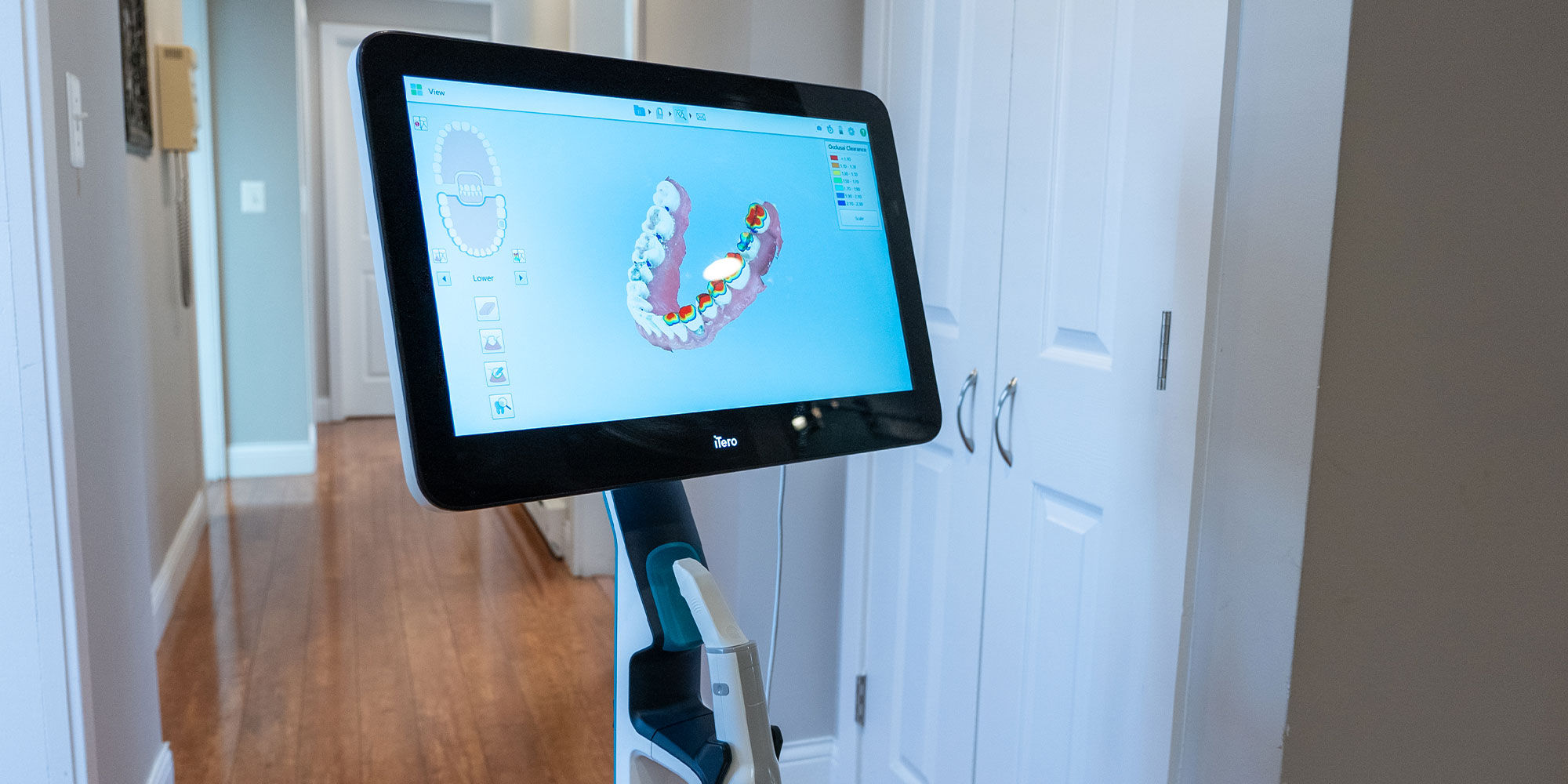 cerec digital scan