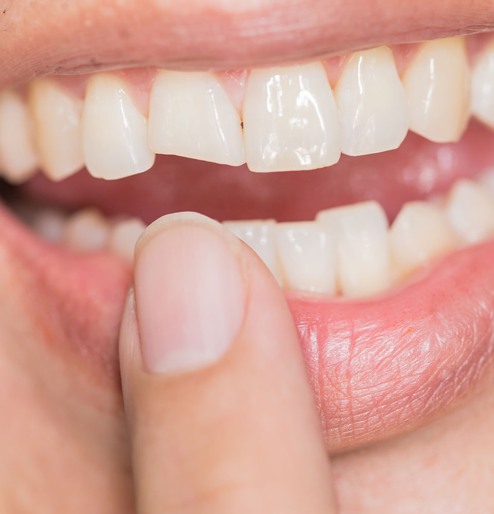 cracked tooth