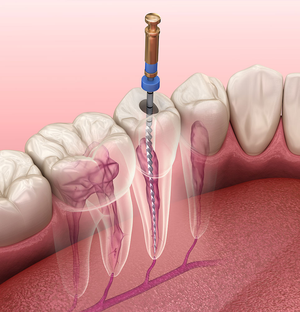 root canal