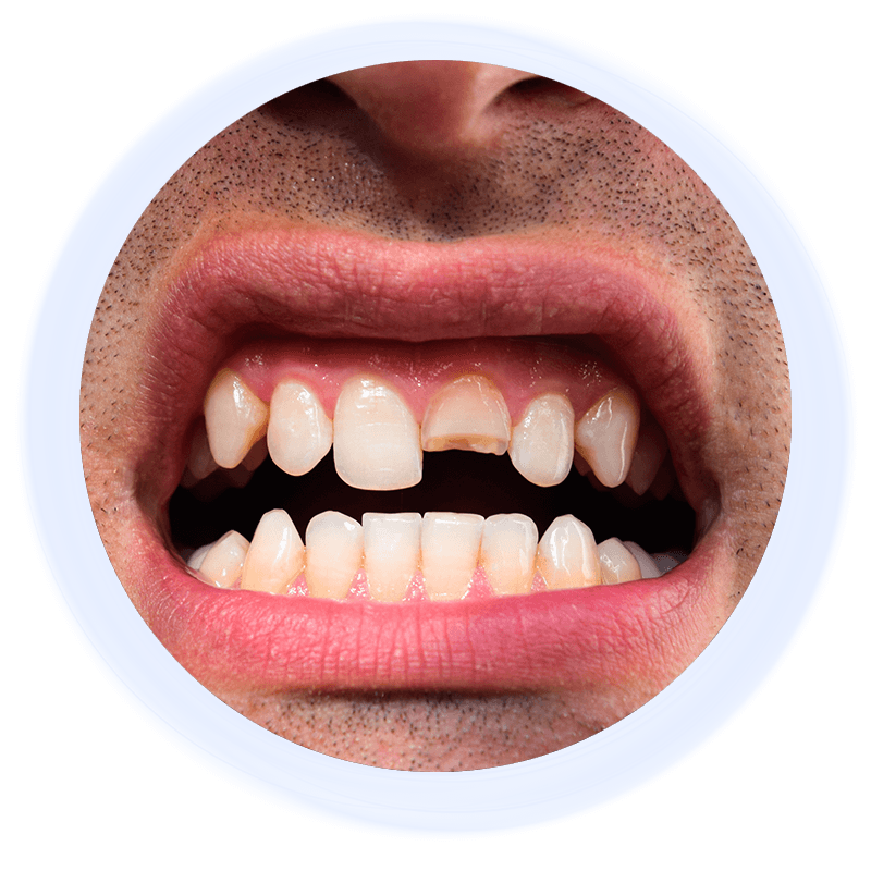 chipped tooth