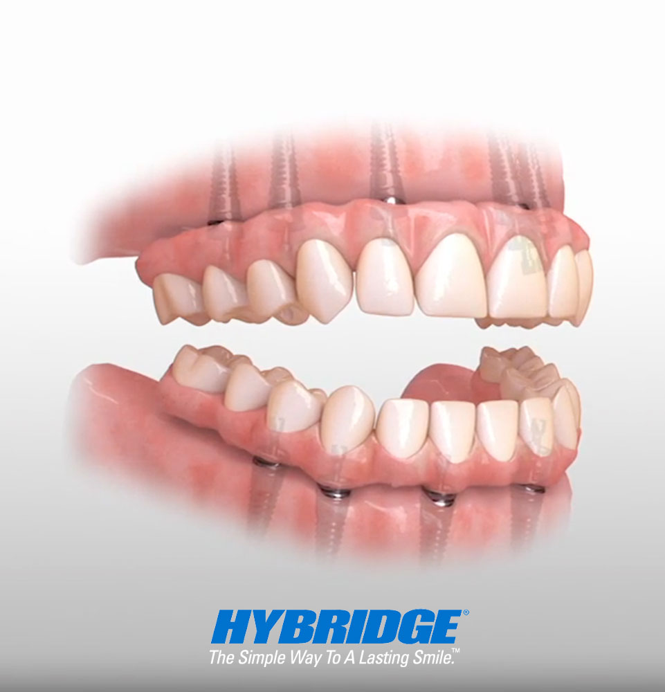 hybridge full arch system ™️ trademarked
